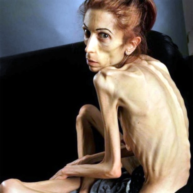 Americana que pesava 18 kg mostra recuperação pós-anorexia bancada com doações online