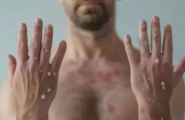 Homem com varíola dos macacos Foto: Getty Images 