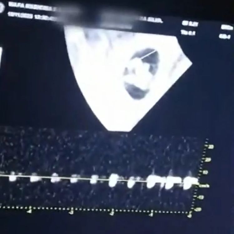Imagem que mostrava a gestação dos quíntuplos - Foto: Reprodução/ TV Globo