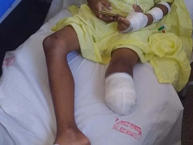 Menino de 09 anos tem perna amputada após cair de ônibus escolar no Piauí